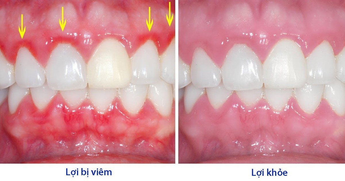 Nguyên nhân gây bệnh viêm lợi và cách điều trị - Tuổi Trẻ Online