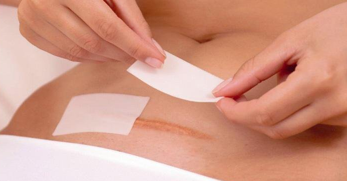 Chăm sóc vết mổ ra sao để tránh nhiễm trùng và sẹo lồi?