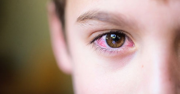 Cách nhận biết đau mắt đỏ có bị sốt không bằng các triệu chứng đi kèm