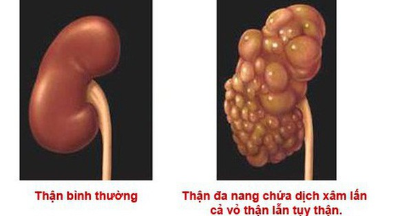 Có những biến chứng nào có thể xảy ra nếu không phát hiện và điều trị sớm cho bệnh thận?
