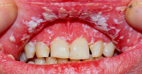 Những dấu hiệu của viêm khoang miệng là gì? 
