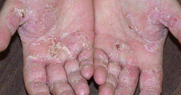 Nguyên nhân gây mụn nước ở bàn chân là gì?
