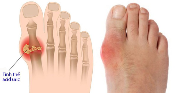 Các triệu chứng của bệnh gout là gì?
