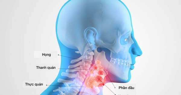 Ung thư vòm họng có những triệu chứng như thế nào?
