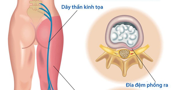 Đau thần kinh tọa - Tuổi Trẻ Online