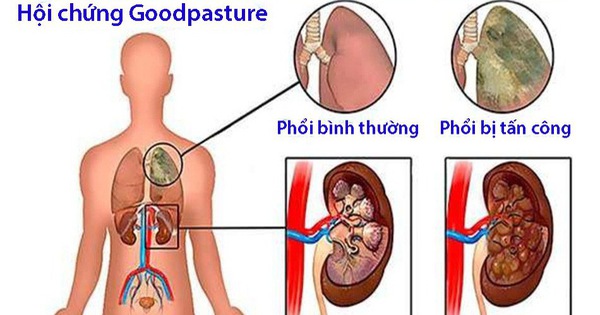 Hội chứng Goodpasture gây tổn thương ở phổi và thận như thế nào?
