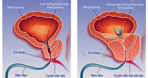 Sự kết hợp giữa thuốc và phương pháp điều trị nào hiệu quả nhất trong điều trị phì đại tiền liệt tuyến?
