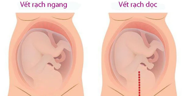 Tìm hiểu cách trị ngứa vết mổ sau sinh 2 năm hiệu quả và an toàn