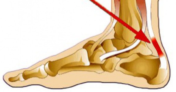 Tại sao nên đi khám và chữa trị kịp thời khi bị đau gót chân trái?