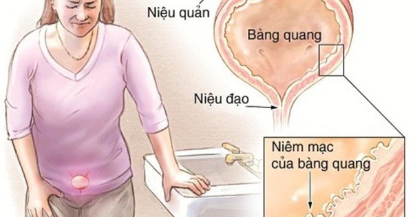 Người bị viêm bàng quang có nên hạn chế quan hệ tình dục không?
