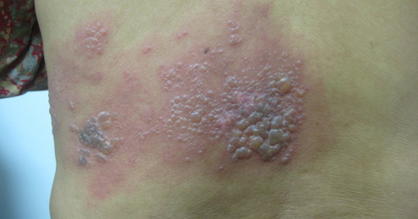 Tác động của virus varicella zoster lên dây thần kinh như thế nào trong giai đoạn này?
