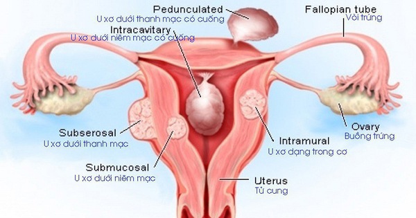 U xơ tử cung thoái hoá là gì? 

