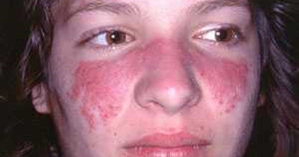 Lupus ban đỏ có được coi là bệnh di truyền không?
