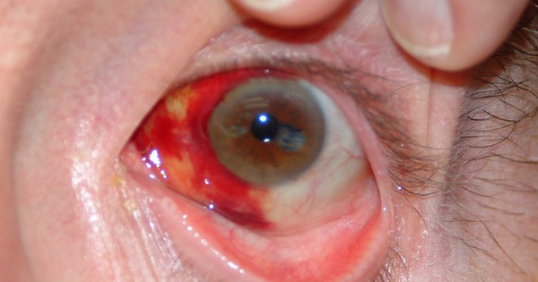 What are the causes and symptoms of chảy máu con mắt (bleeding in the eye)?