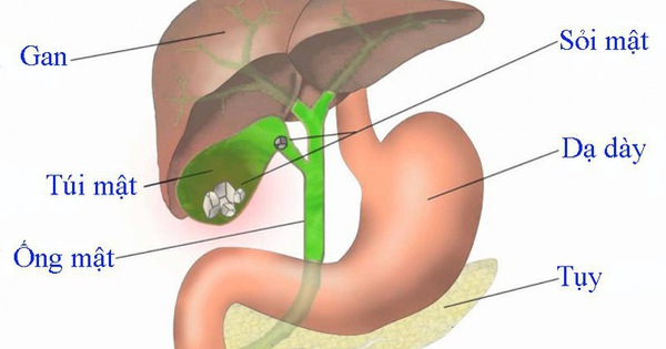 What are some preventive measures to avoid viêm túi mật?
