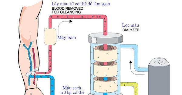 Tại sao phế cầu khuẩn thường trú trong hầu họng có thể gây nguy cơ chạy thận cao?
