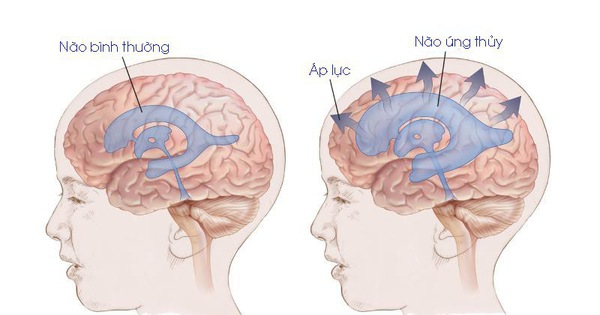 Có phải tất cả các trường hợp trẻ sơ sinh bị dấu hiệu này đều cần điều trị?
