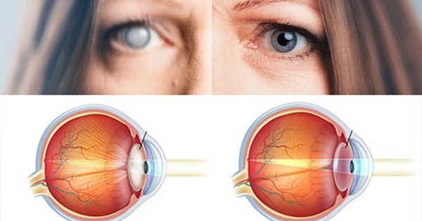 Phòng ngừa và chữa trị các bệnh về mắt ở người già hiệu quả và an toàn