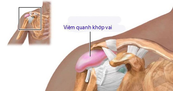 Có những biến chứng nào có thể xảy ra do viêm quanh khớp vai thể đông cứng?
