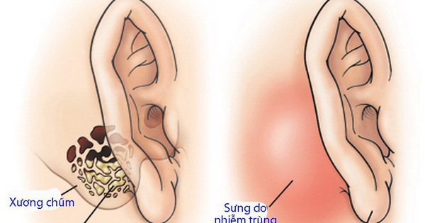 Tại sao viêm xương chũm tai cần được điều trị kịp thời?