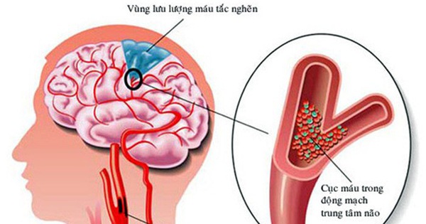 Dấu hiệu và cách xử trí cơn thiếu máu não thoáng qua - Tuổi Trẻ Online