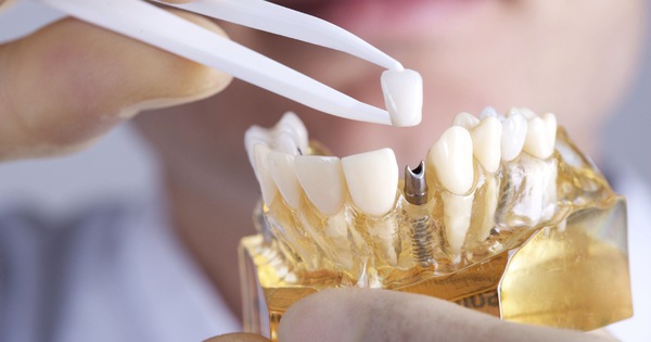 Có cách nào để tái cấy răng implant sau khi bị rơi rớt?
