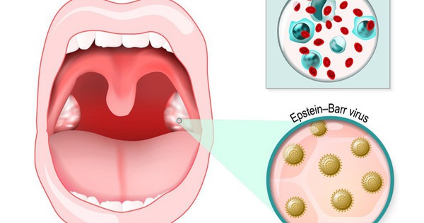 Làm sao để chẩn đoán nhiễm EBV? Chẩn đoán nhiễm EBV được thực hiện thông qua các xét nghiệm máu để phát hiện các kháng thể chống EBV.
