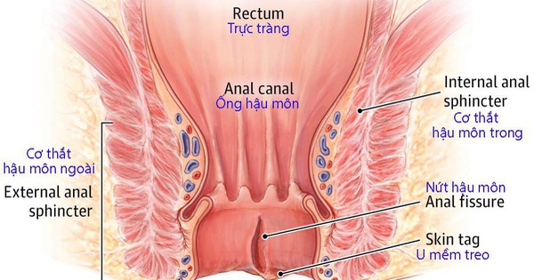 Cách điều trị viêm da hậu môn như thế nào?
