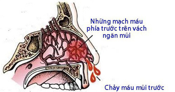 Chảy máu mao mạch là gì và có các triệu chứng như thế nào?
