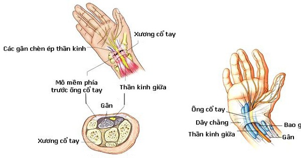 Thông tin về bị tê 2 bàn tay là bệnh gì bạn cần biết