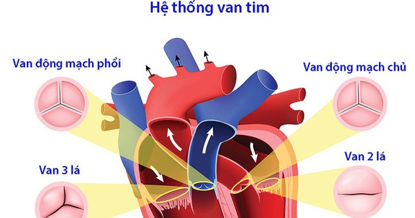 Nguyên nhân gây đứt dây chằng van tim là gì? 
