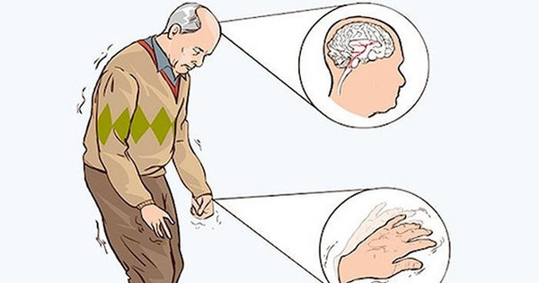 Bệnh Parkinson là gì và diễn biến ra sao ở người già?
