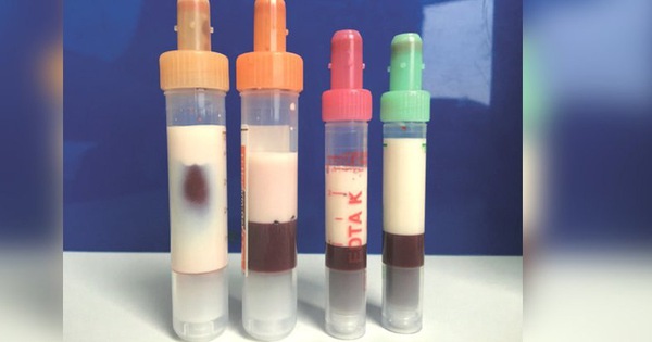 Cách xác định mỡ máu nhiễm mỡ qua các xét nghiệm sinh hóa máu?