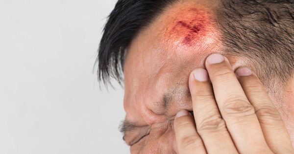 7 dấu hiệu cho thấy bạn cần đi cấp cứu sau một chấn thương đầu