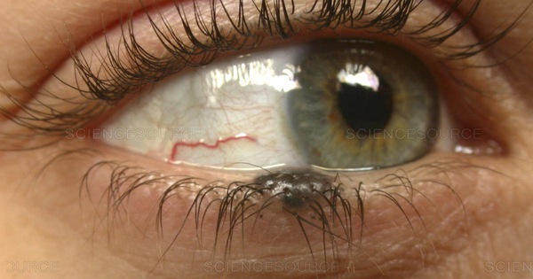  Nốt ruồi ở mí mắt dưới có tẩy được không – Bí quyết xóa tan nỗi lo