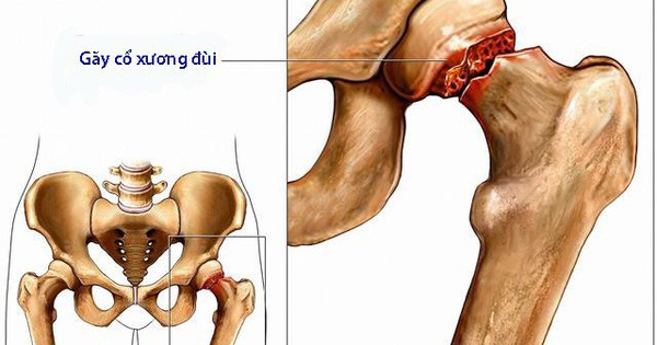 Viêm khớp hông có thể gây biến chứng gì?
