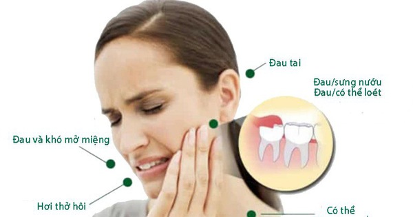 Thuốc giảm đau khi mọc răng khôn có hiệu quả trong bao lâu sau khi sử dụng?

