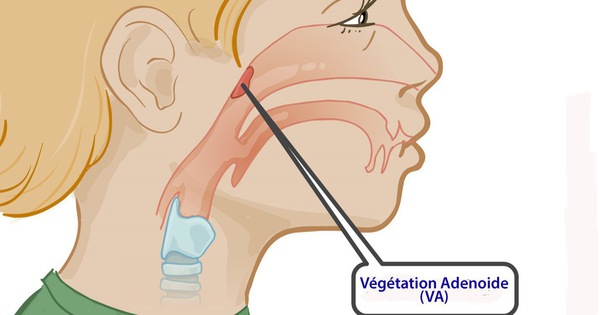 Có cách phòng ngừa viêm VA ở trẻ em không?