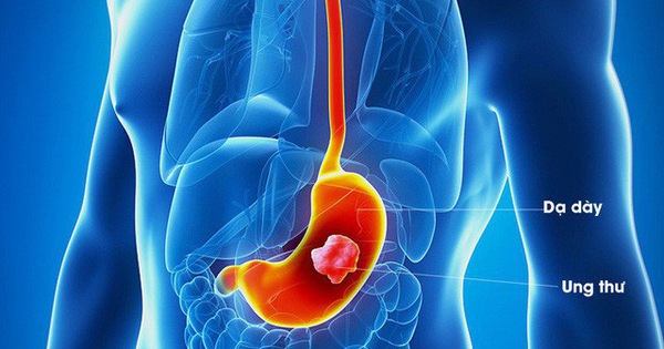 Hóa chất nào có thể gây đau bụng sau khi truyền?
