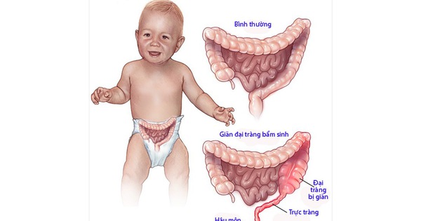 Nguyên nhân gây ra bệnh giãn đại tràng bẩm sinh là gì?
