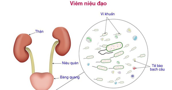 Những nguyên nhân gây hội chứng niệu đạo là gì?
