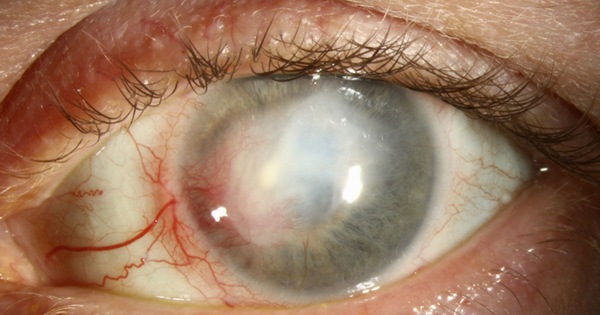 Cách phát hiện và chẩn đoán bệnh viêm giác mạc do Herpes mắt?
