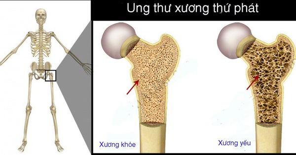 Nguyên nhân gây ra sự di căn của ung thư vào xương?
