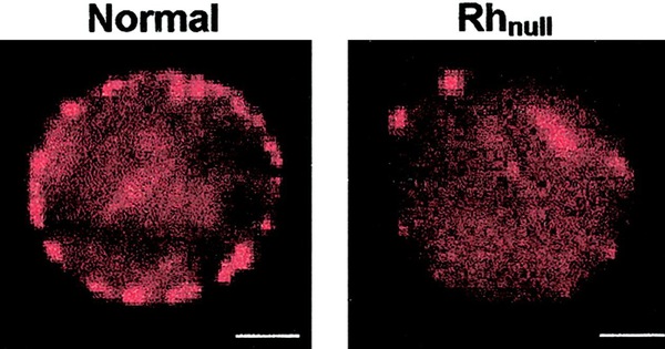 Nhóm máu Rh-null có những đặc điểm gì đặc biệt về cấu trúc tế bào hồng cầu?
