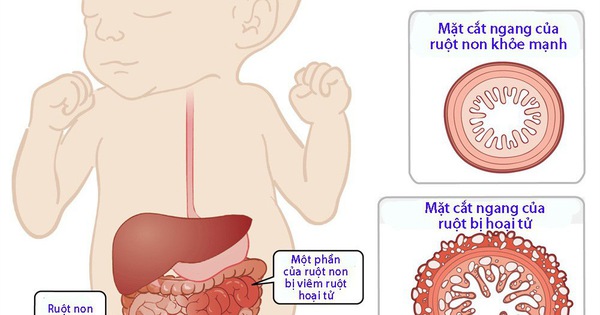 Có những biện pháp nào để phòng ngừa viêm ruột thừa ở trẻ em?
