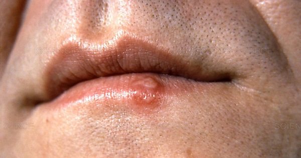 Mụn rộp quanh miệng có triệu chứng và biểu hiện như thế nào?
