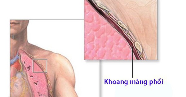 Đau ngực kiểu màng phổi là triệu chứng của những bệnh gì?
