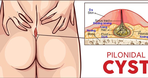 Triệu chứng của u nang lông ở mông là gì?
