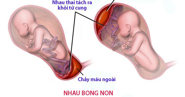 Khám thai định kỳ có thể giúp phát hiện và giải quyết tình trạng rỉ máu khi mang thai sớm không?