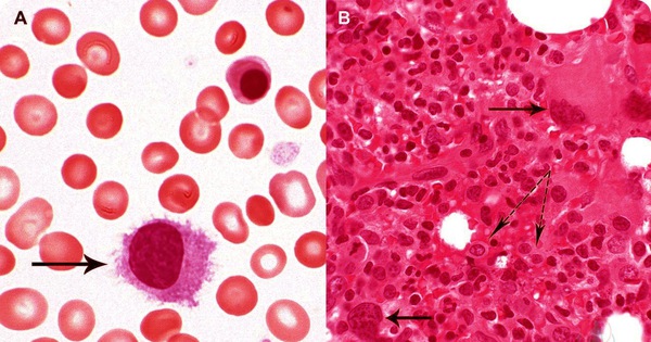 Các tế bào thực bào của lách và gan đóng vai trò gì trong việc tiêu hủy hồng cầu cũ?
